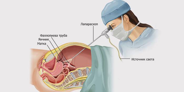Sơ đồ mổ nội soi