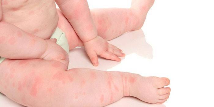 Manifestationer af kropsallergier hos et barn
