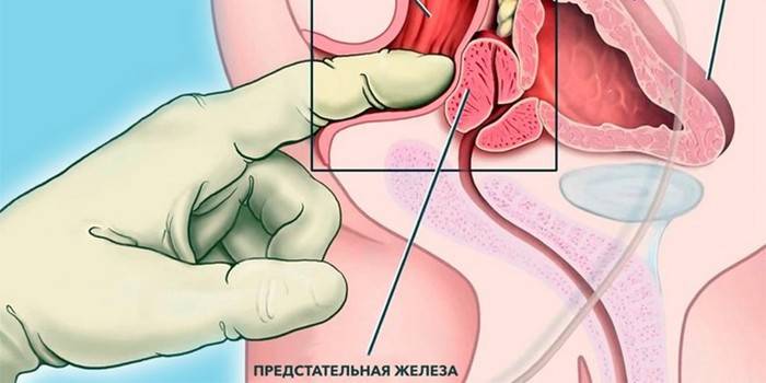 Prostatas masāžas shēma