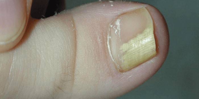 Ongle atteint par un champignon