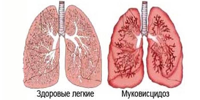Plămânele sănătoase și afectate de fibroza chistică, schema