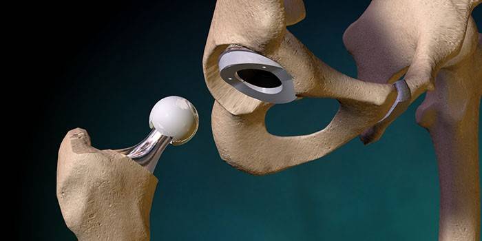 implant
