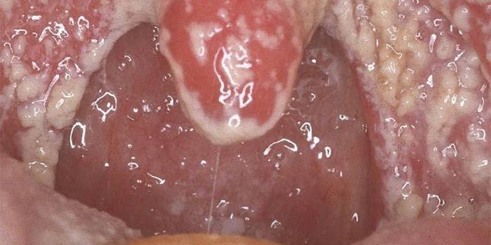 Candidosi nella mucosa orale