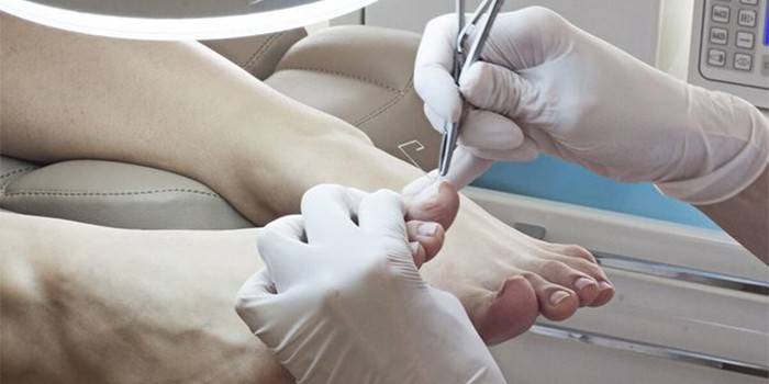 L'erba medica rimuove un chiodo sulla gamba del paziente