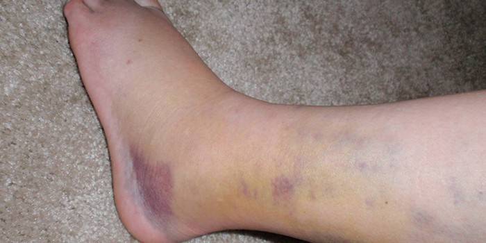 Contusions a la cama inflada