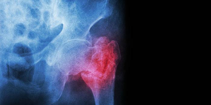 Radiografie a unei fracturi a gâtului femural
