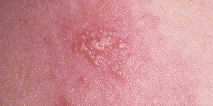 Manifestações do vírus do herpes na pele humana