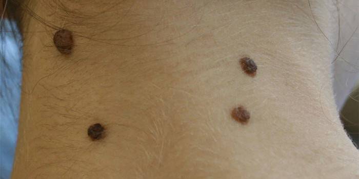 Papillomatous nevus sau gáy của một cô gái