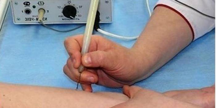 Rimozione di papillomi mediante elettrocoagulazione
