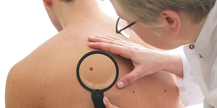 Bác sĩ kiểm tra nevus trên lưng bệnh nhân thông qua kính lúp