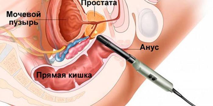 Prostat biyopsisi çizimi