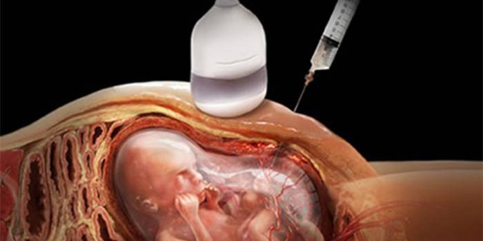 Procedura de screening a sarcinii