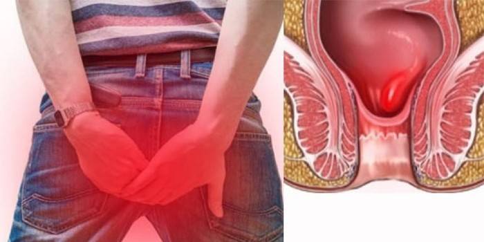 Un homme tient ses mains derrière son dos et dessine une hémorroïdes