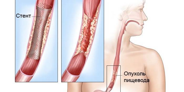 Stentarea cancerului esofagian
