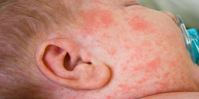Allergischer Ausschlag im Gesicht des Kindes