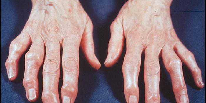 มือของผู้หญิงกับ osteoarthrosis ของข้อต่อของนิ้วมือ