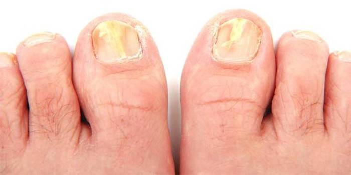 Micosi delle unghie dei piedi