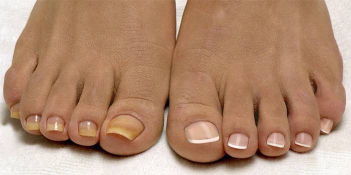Ongles malades et en bonne santé
