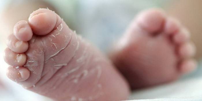 Decojirea pielii pe picioarele unui nou-născut