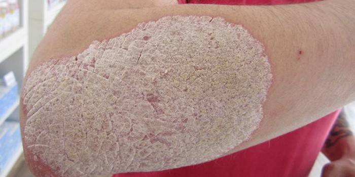Psoriasis en la piel del codo.