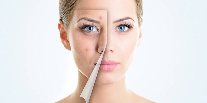 Slip af acne på en piges ansigt