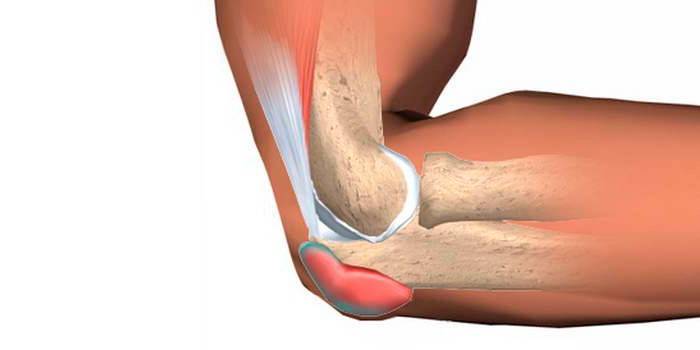 Das Schema der Bursitis des Ellbogengelenks