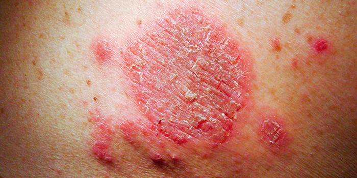Eczema na pele humana