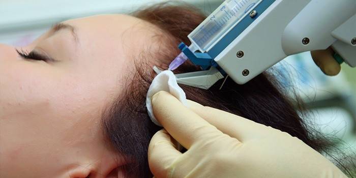 ผู้หญิงได้รับ Mesotherapy ของหนังศีรษะ