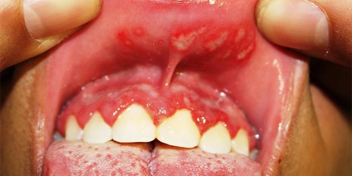 Candidiasis στη γλώσσα και στοματικό βλεννογόνο ενός ατόμου