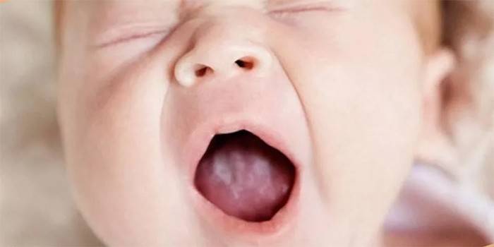 Placca bianca nella bocca del bambino