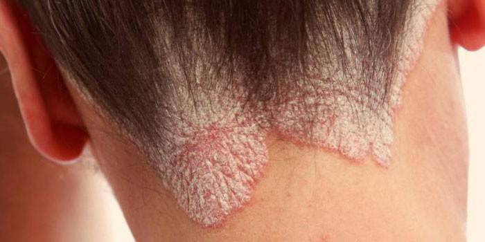 Cuero cabelludo afectado por psoriasis