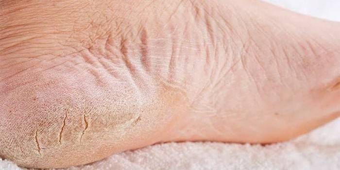 Nấm Plantar trên chân người