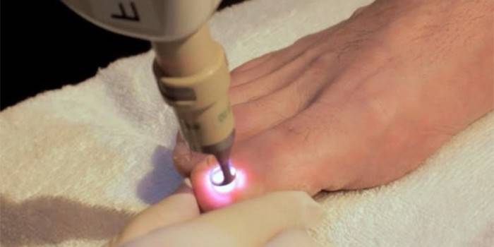 Procédure de traitement au laser
