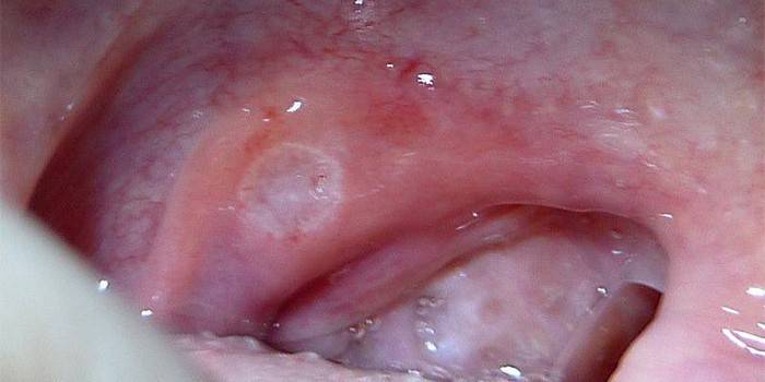 הביטוי של stomatitis