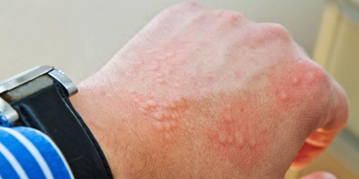 Dyshidrotisches Ekzem auf der Handhaut