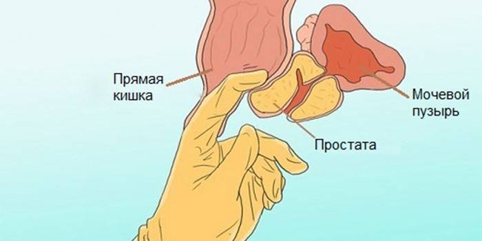 Técnica de masaje de próstata