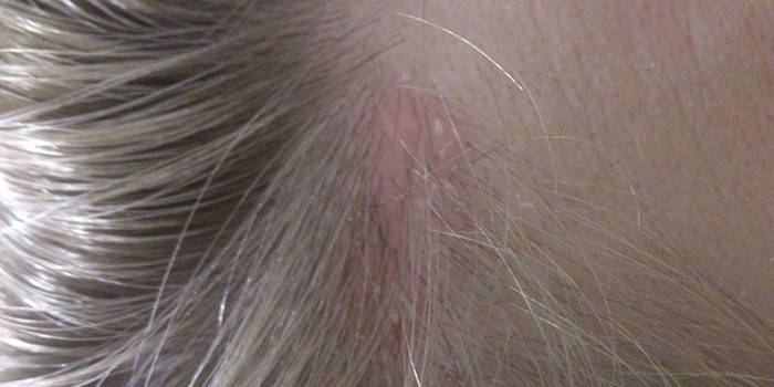 Pityriasis roșu versicolor pe scalp