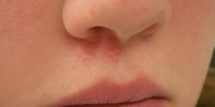 Manifestationen von Herpes unter der Nase