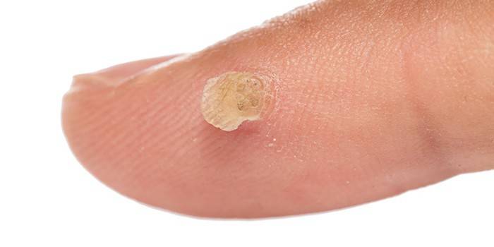 Papilloma sul dito