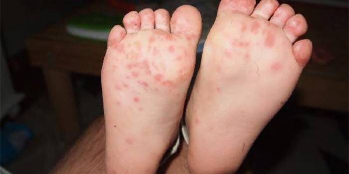 รูปแบบ Dyshidrotic ของเชื้อราบนเท้าของบุคคล