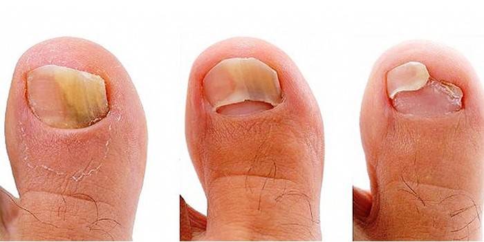 Étapes d'infection fongique des ongles