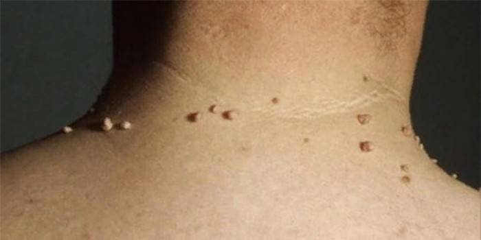 Papillomi sul collo di un uomo