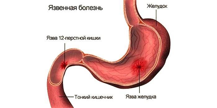 Loét dạ dày