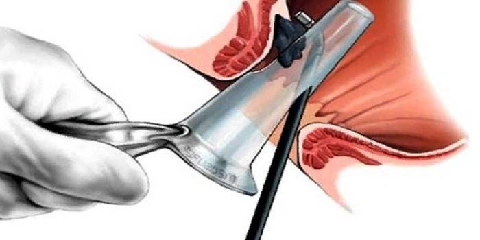 Dahili hemoroidler için lazer giderme şeması