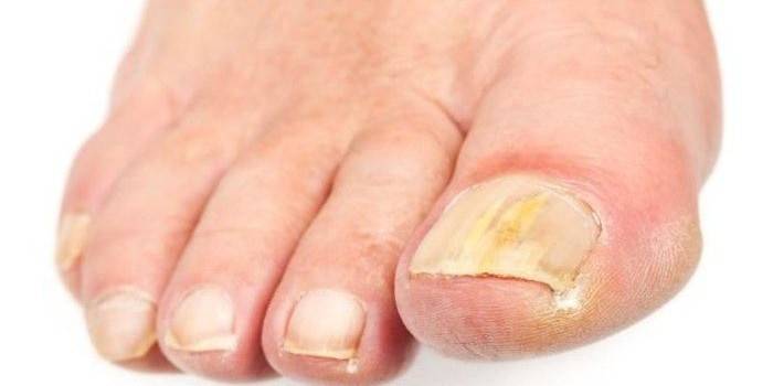 Móng chân bị ảnh hưởng bởi nấm