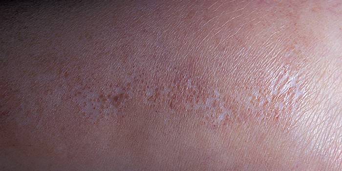 Dermatóza na ľudskej koži