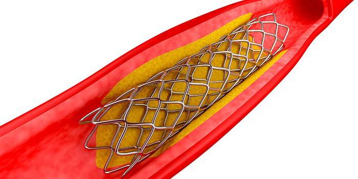 Kuģa stents