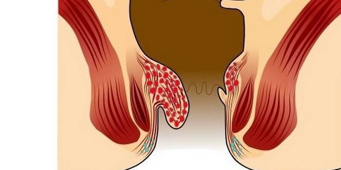 Đề án phát triển bệnh trĩ