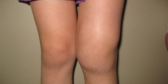 Rodilla deformada