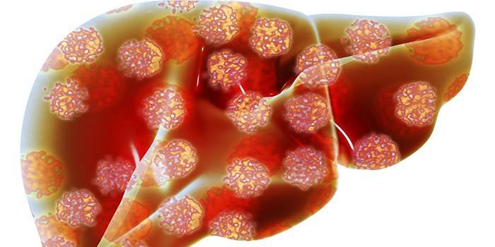 Hepatitis-betroffene Leber